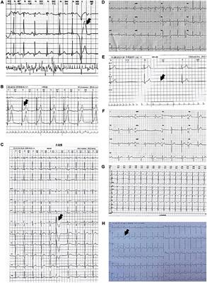 Congenital Anomalous Origin of Coronary Artery Disease in Children With Syncope: A Case Series